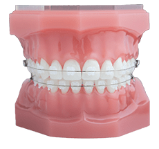 clear braces