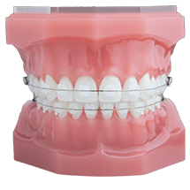 clear braces draper
