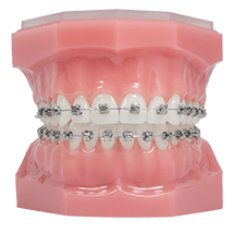 metal braces draper